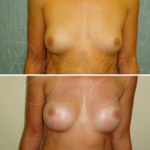 breast enlargement surgeons malaga