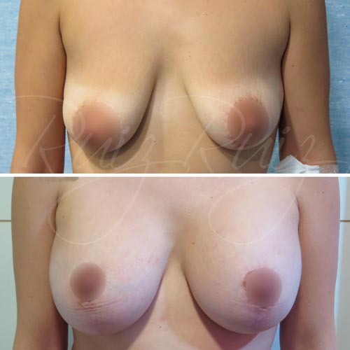 breast lift scar malaga
