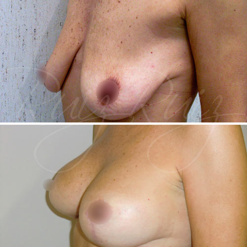 breast lift price spain malaga