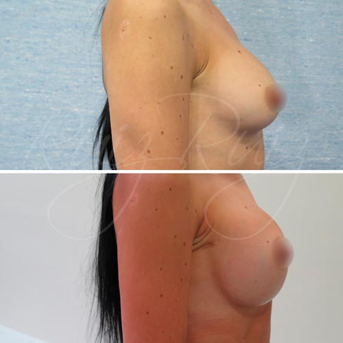 breast reconstruction in malaga