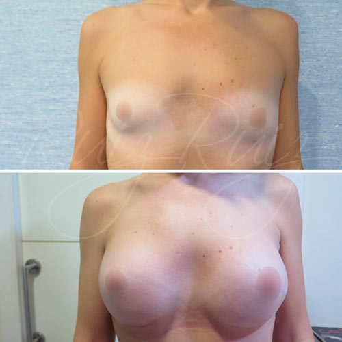 malaga breast cancer reconstruction