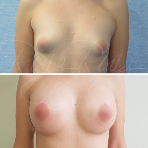 breast reconstruction malaga