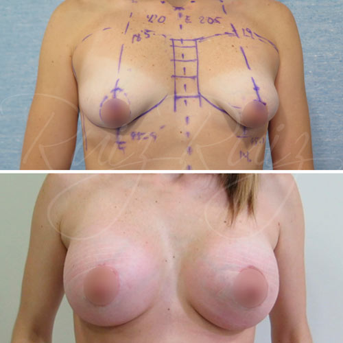 breast reconstruction types