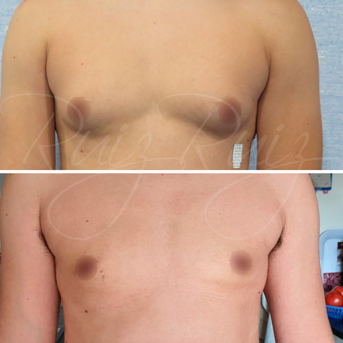 gynecomastia surgery before and after malaga
