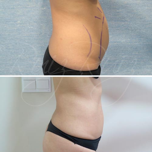 before and after liposuction malaga