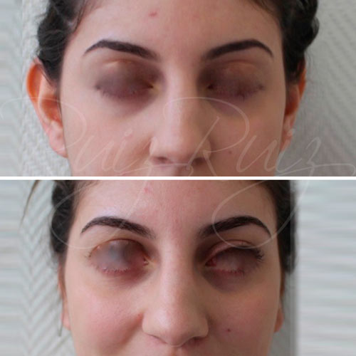 otoplasty before after malaga
