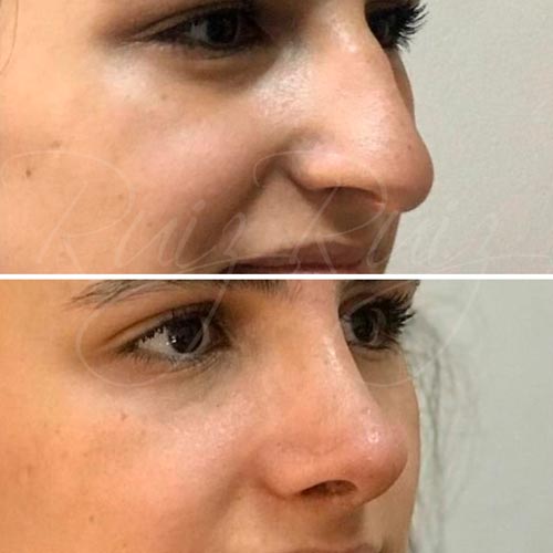 before and after rhinoplasty malaga