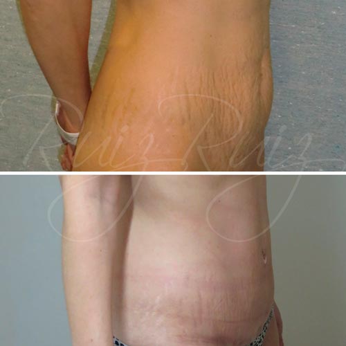 tummy tuck before and after malaga